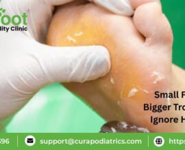 Foot Corn Causes And Treatment