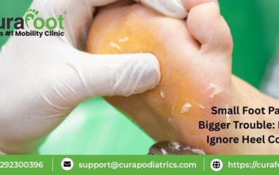 Foot Corn Causes And Treatment
