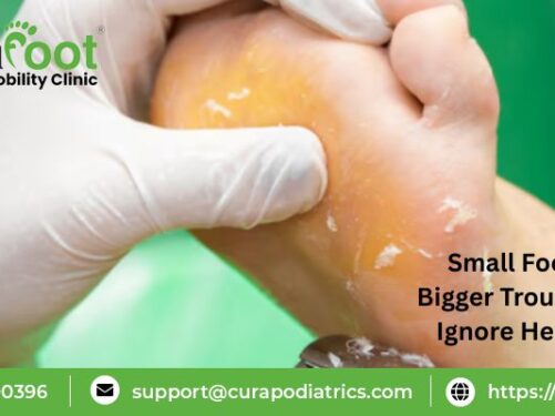 Foot Corn Causes And Treatment