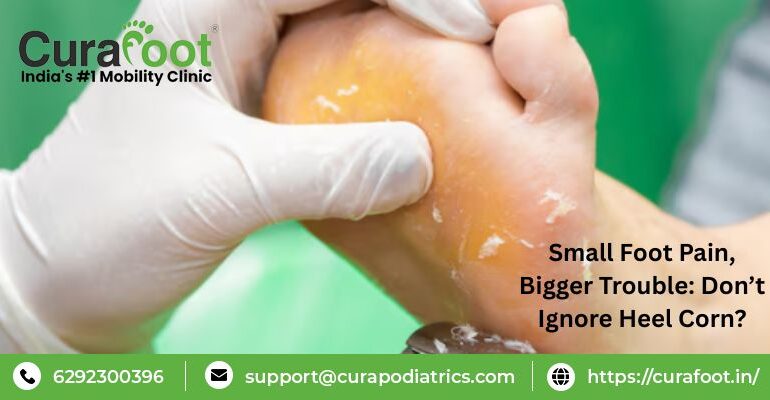 Foot Corn Causes And Treatment
